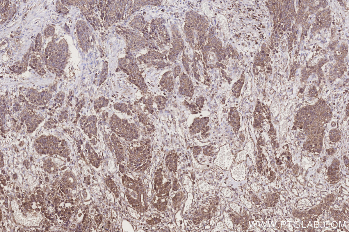 Immunohistochemical analysis of paraffin-embedded human stomach cancer tissue slide using KHC3273 (FUT8 IHC Kit).