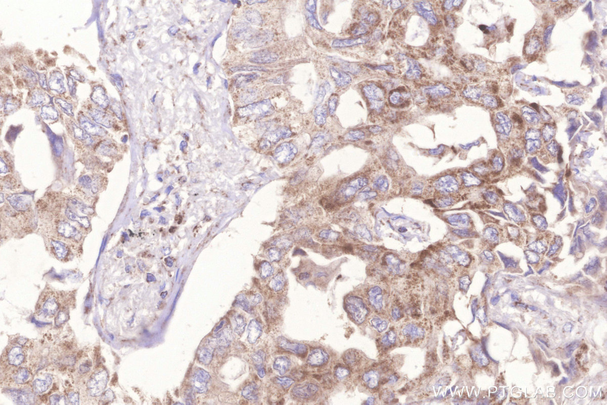 Immunohistochemical analysis of paraffin-embedded human lung cancer tissue slide using KHC3257 (Frataxin IHC Kit).
