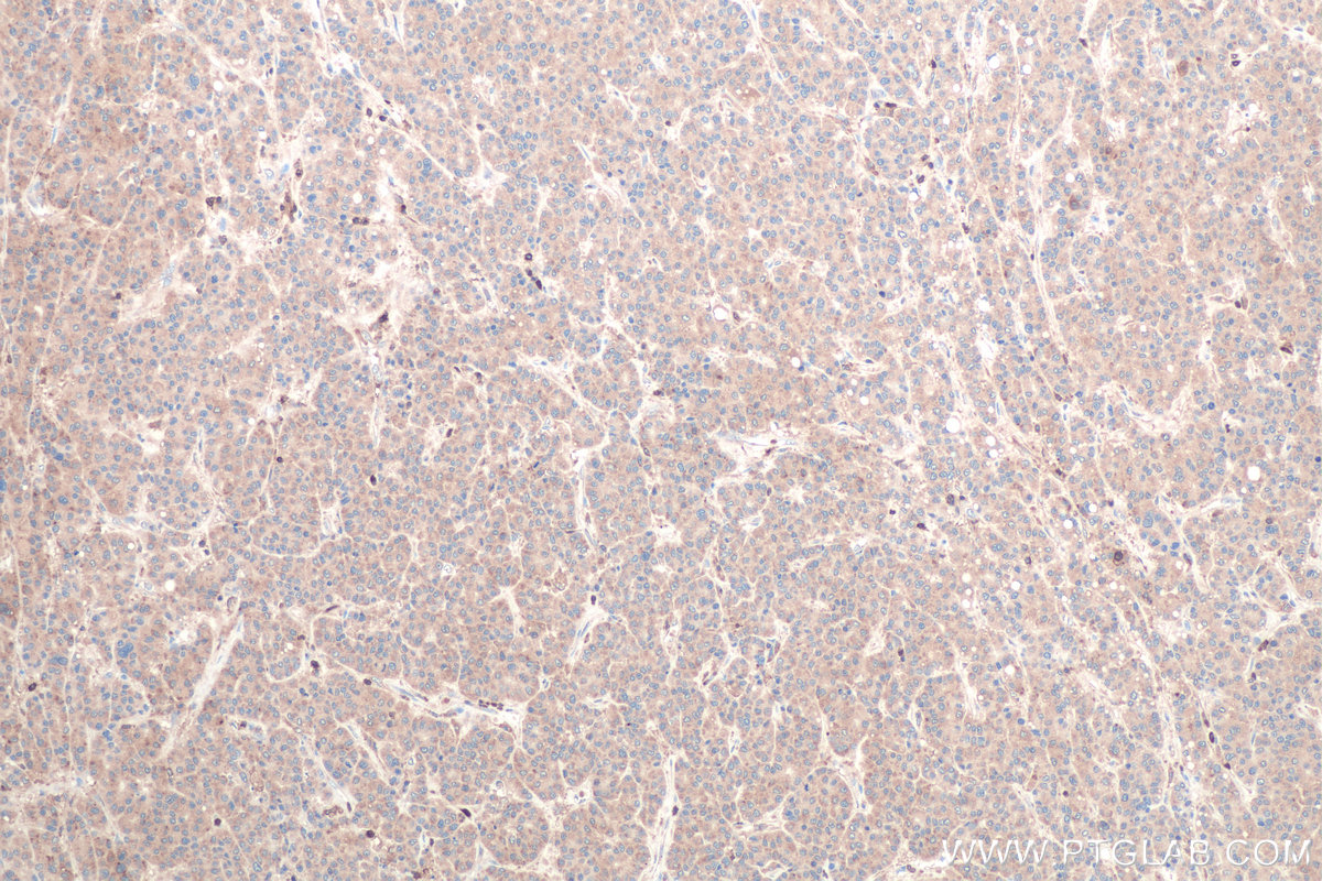 Immunohistochemical analysis of paraffin-embedded human liver cancer tissue slide using KHC0876 (G6PD IHC Kit).