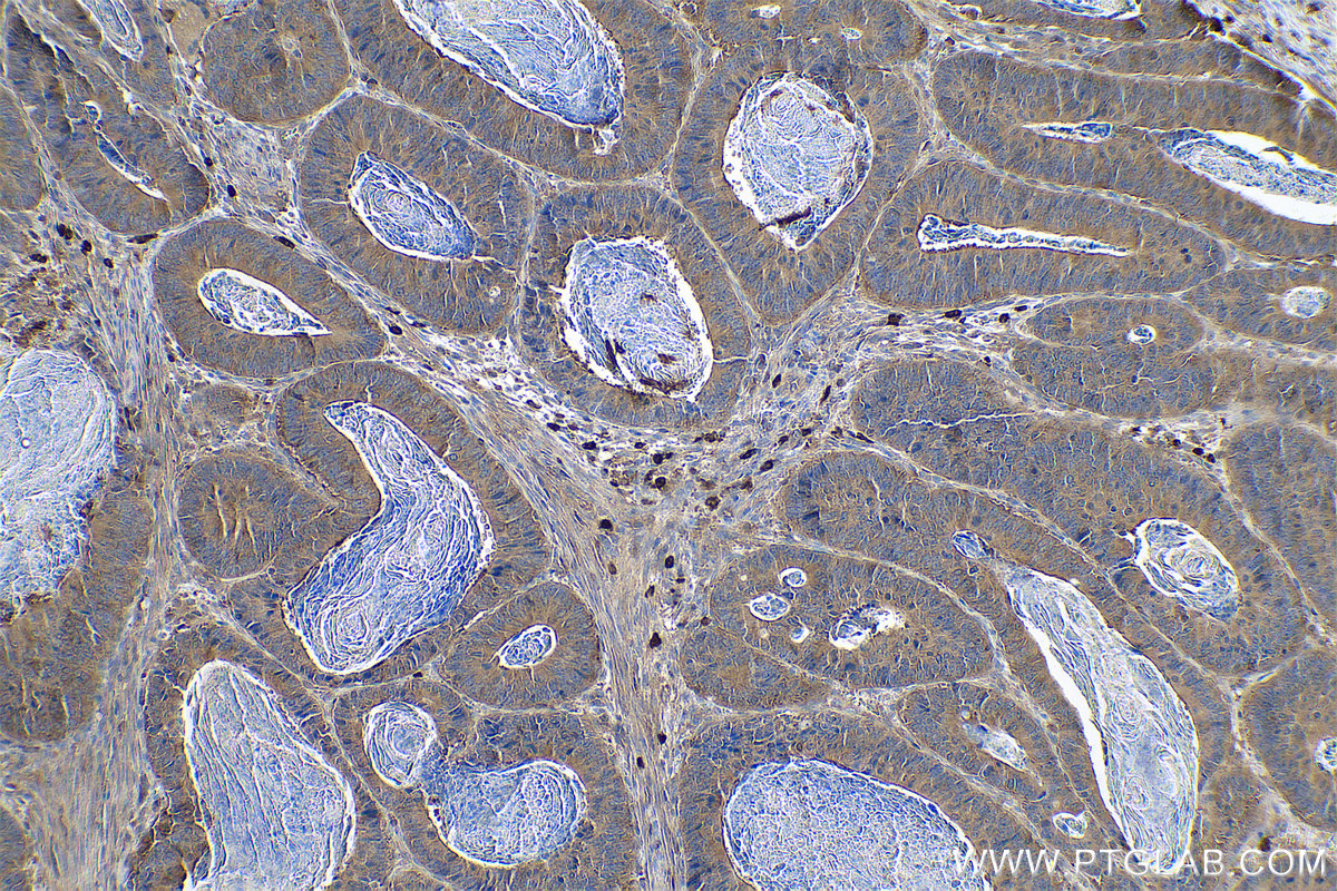 Immunohistochemical analysis of paraffin-embedded human colon cancer tissue slide using KHC0876 (G6PD IHC Kit).