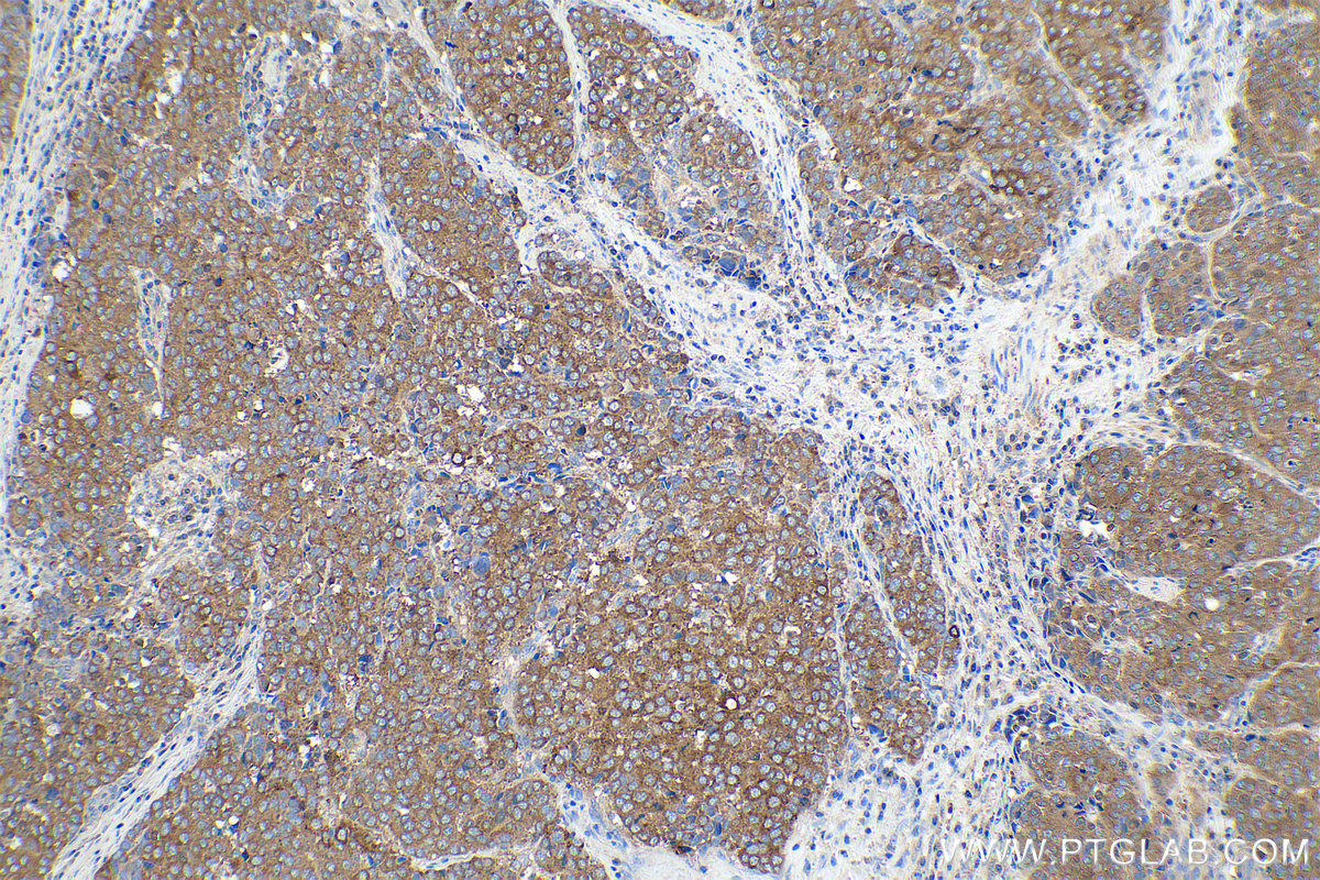 Immunohistochemical analysis of paraffin-embedded human stomach cancer tissue slide using KHC0876 (G6PD IHC Kit).