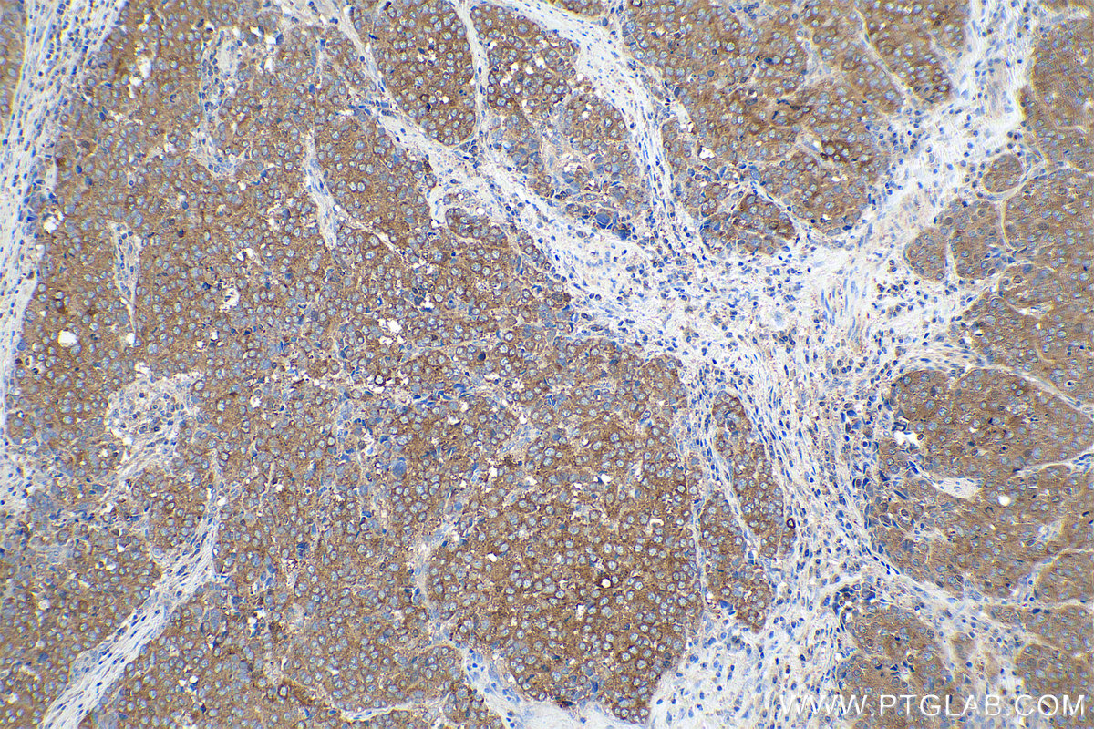 Immunohistochemical analysis of paraffin-embedded human stomach cancer tissue slide using KHC0876 (G6PD IHC Kit).