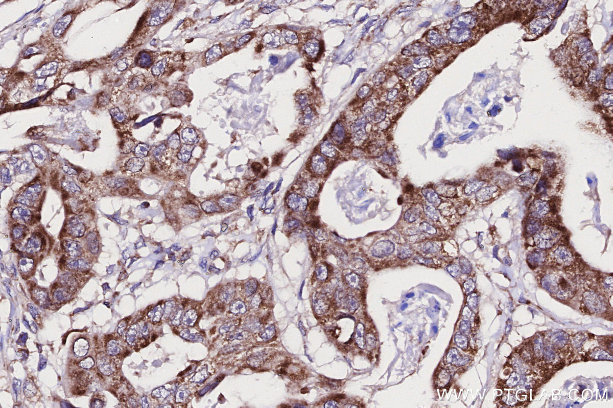 Immunohistochemical analysis of paraffin-embedded human stomach cancer tissue slide using KHC2704 (GADD45GIP1 IHC Kit).