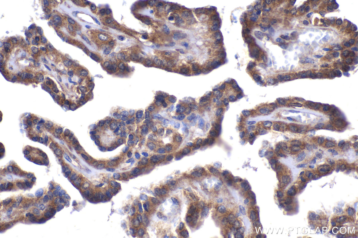 Immunohistochemical analysis of paraffin-embedded human thyroid cancer tissue slide using KHC2065 (GAK IHC Kit).