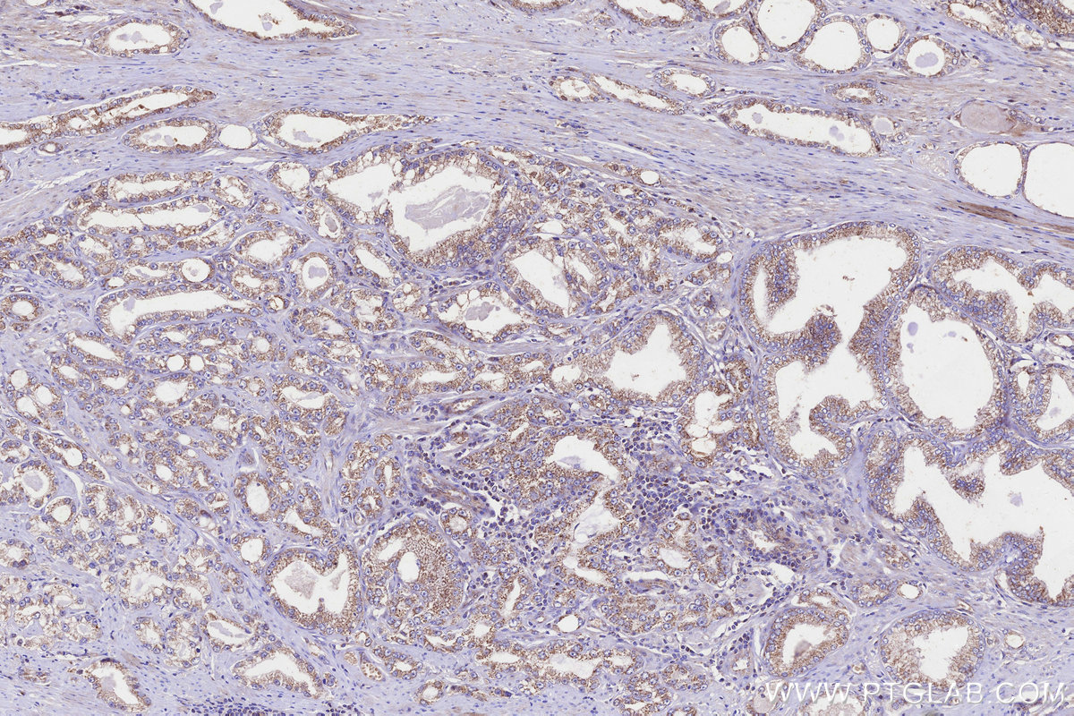 Immunohistochemical analysis of paraffin-embedded human prostate cancer tissue slide using KHC3270 (GALNT17/WBSCR17 IHC Kit).