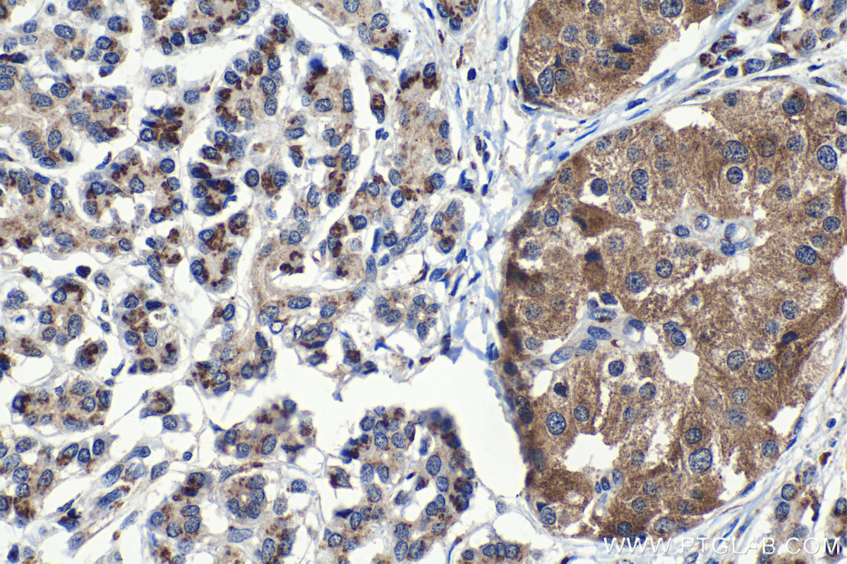 Immunohistochemical analysis of paraffin-embedded human pancreas cancer tissue slide using KHC1226 (GALNT2 IHC Kit).