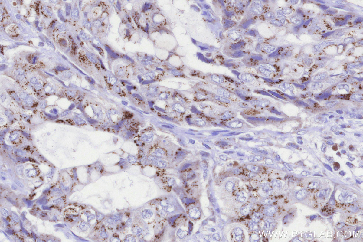 Immunohistochemical analysis of paraffin-embedded human pancreas cancer tissue slide using KHC3288 (GALNT4 IHC Kit).