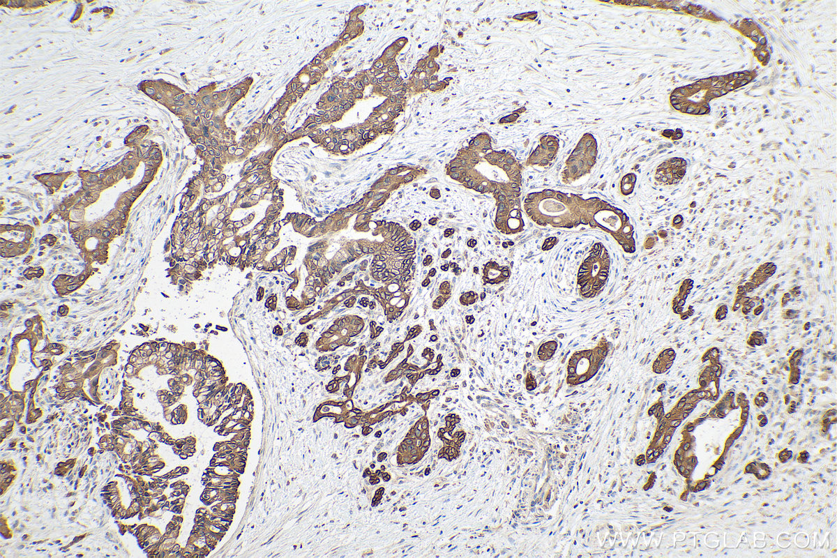 Immunohistochemical analysis of paraffin-embedded human pancreas cancer tissue slide using KHC0810 (GALR2 IHC Kit).