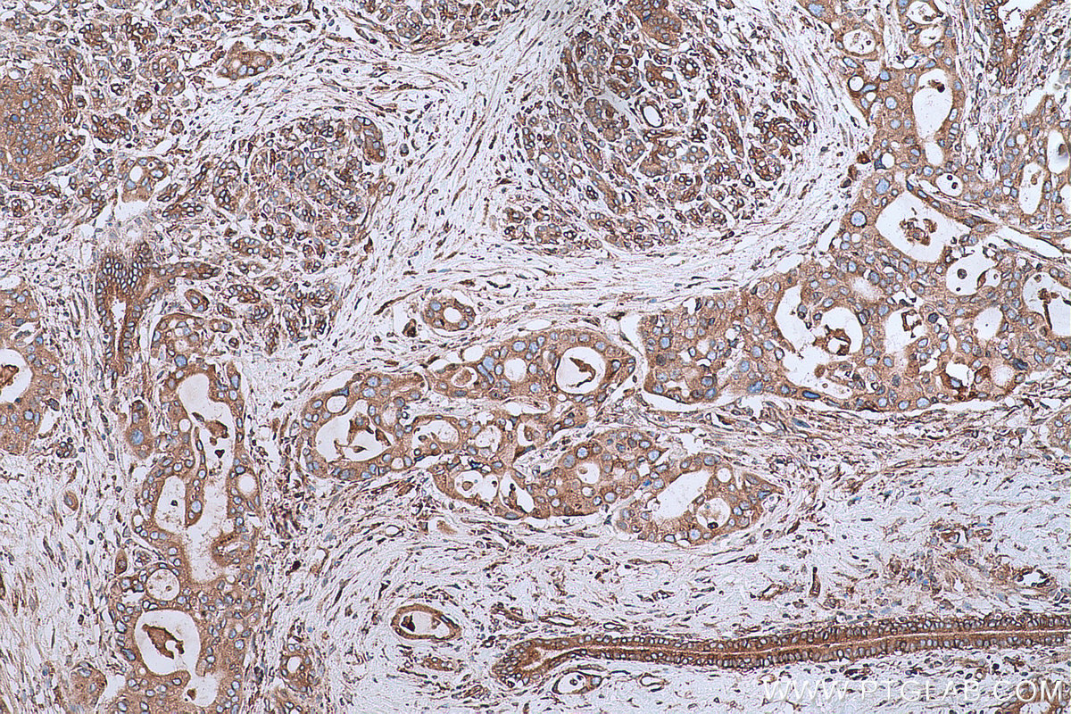 Immunohistochemical analysis of paraffin-embedded human pancreas cancer tissue slide using KHC0666 (GANAB IHC Kit).