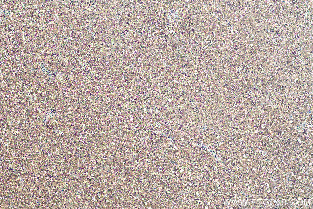 Immunohistochemical analysis of paraffin-embedded human liver cancer tissue slide using KHC0501 (GAPDH IHC Kit).