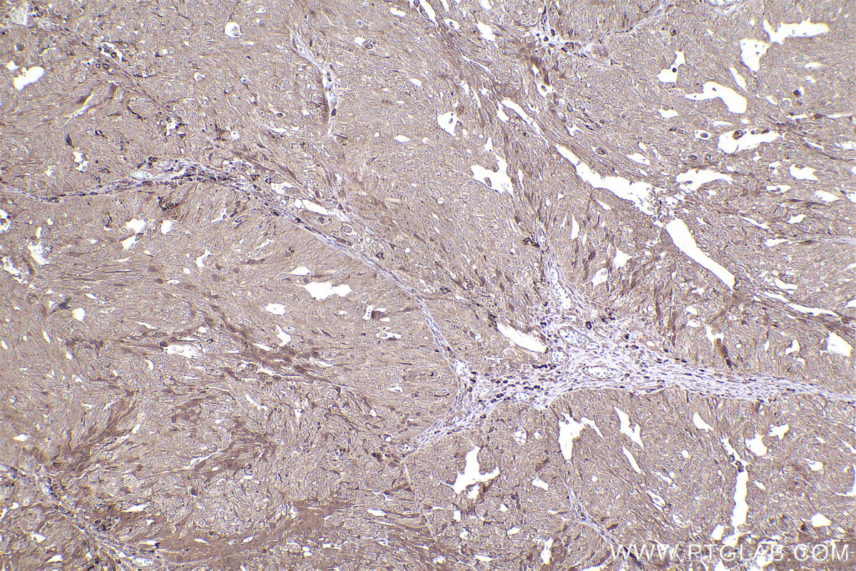 Immunohistochemical analysis of paraffin-embedded human ovary cancer tissue slide using KHC2472 (GAPVD1 IHC Kit).