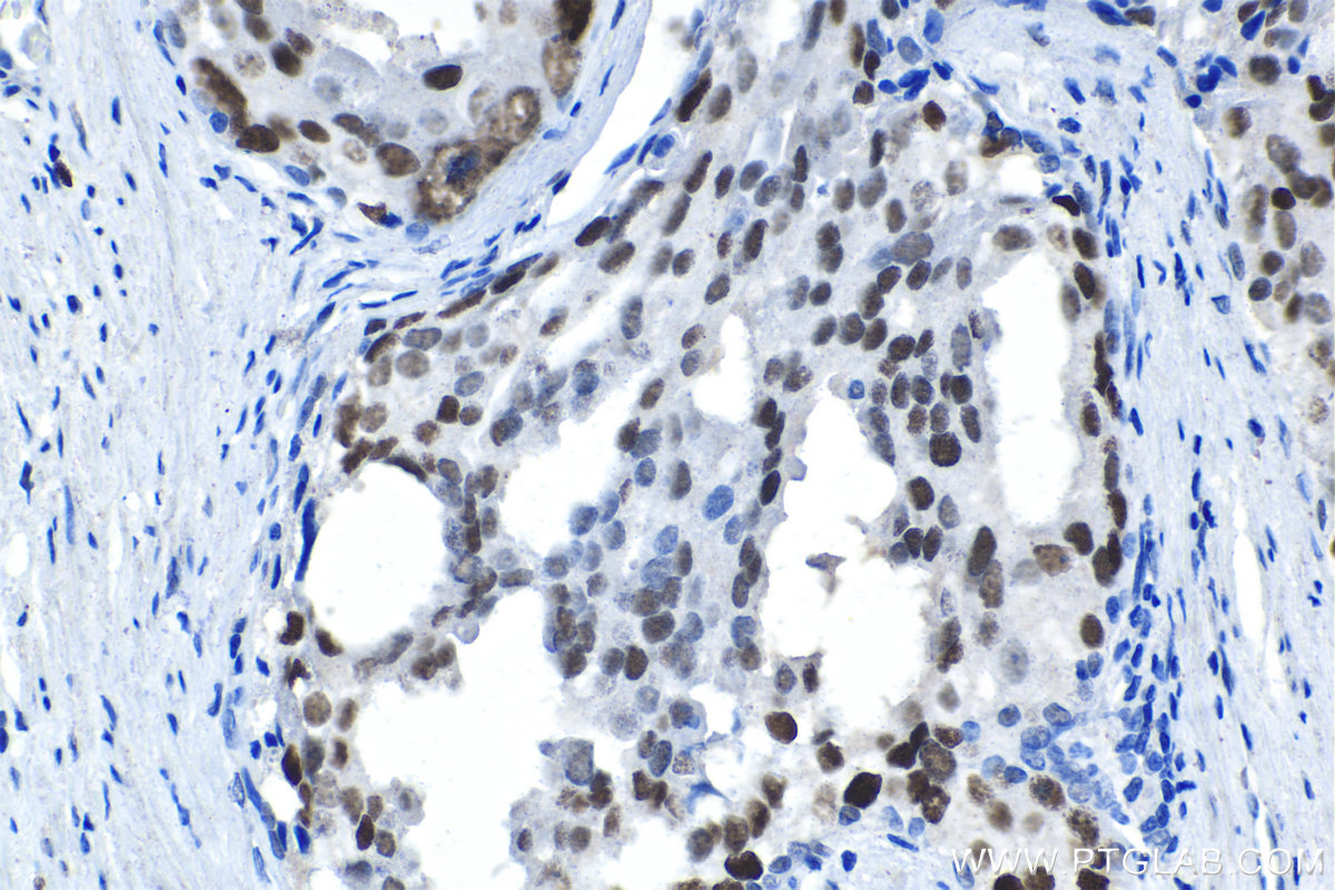 Immunohistochemical analysis of paraffin-embedded human prostate cancer tissue slide using KHC1601 (GATA2 IHC Kit).