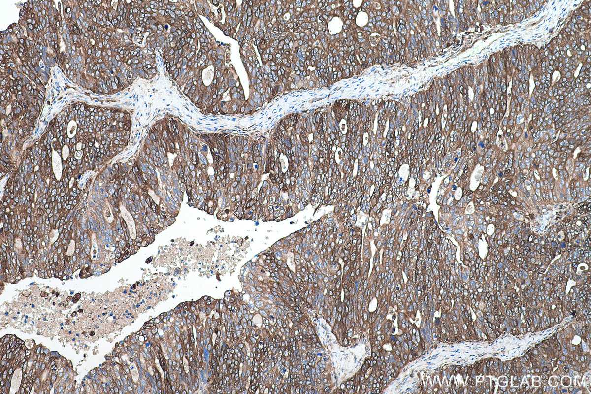 Immunohistochemical analysis of paraffin-embedded human ovary tumor tissue slide using KHC0421 (GBP1 IHC Kit).