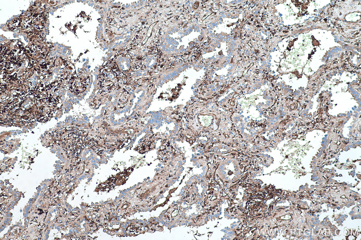 Immunohistochemical analysis of paraffin-embedded human lung cancer tissue slide using KHC0421 (GBP1 IHC Kit).