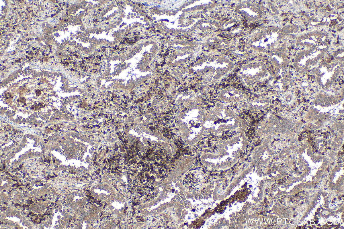 Immunohistochemical analysis of paraffin-embedded human lung cancer tissue slide using KHC1311 (GBP5 IHC Kit).