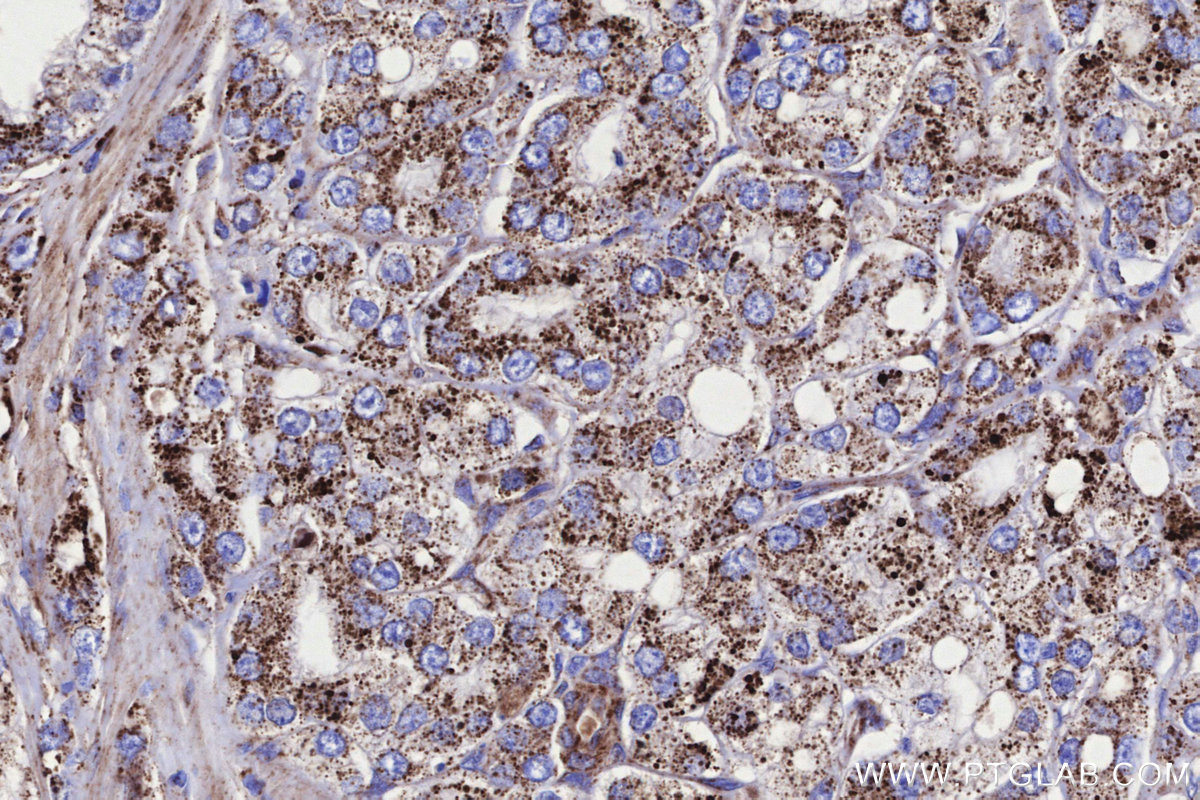 Immunohistochemical analysis of paraffin-embedded human prostate cancer tissue slide using KHC3309 (GCDH IHC Kit).