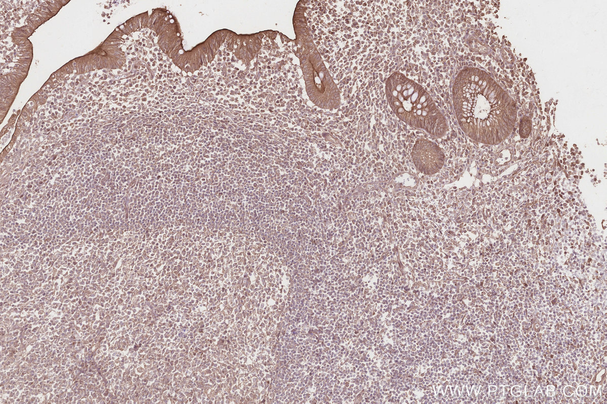 Immunohistochemical analysis of paraffin-embedded human appendicitis tissue slide using KHC2828 (GCP6 IHC Kit).