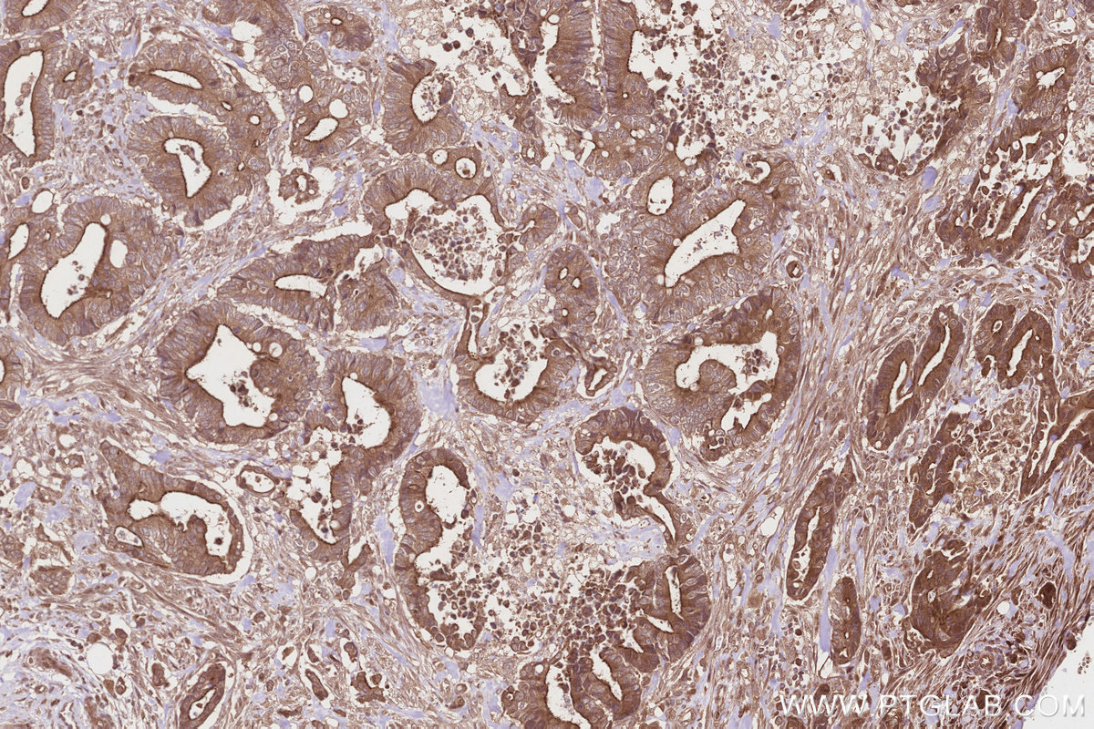 Immunohistochemical analysis of paraffin-embedded human rectal cancer tissue slide using KHC2828 (GCP6 IHC Kit).