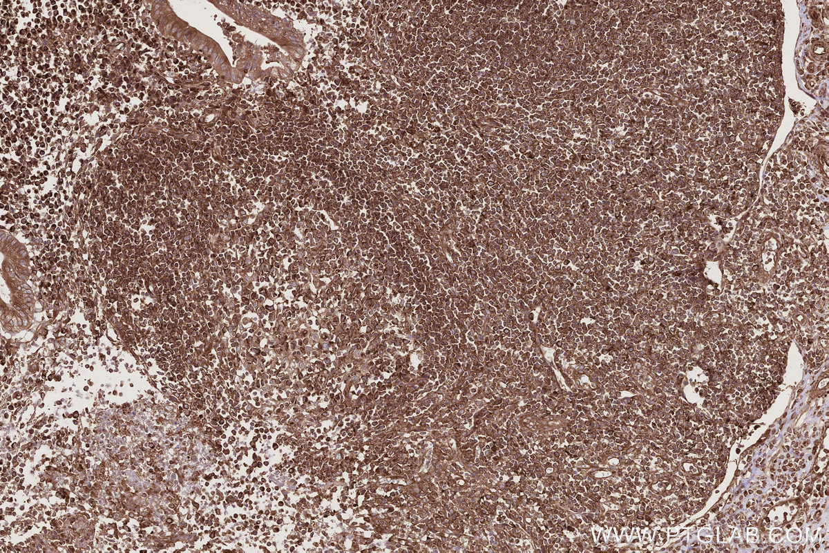 Immunohistochemical analysis of paraffin-embedded human appendicitis tissue slide using KHC2769 (GEF-H1 IHC Kit).