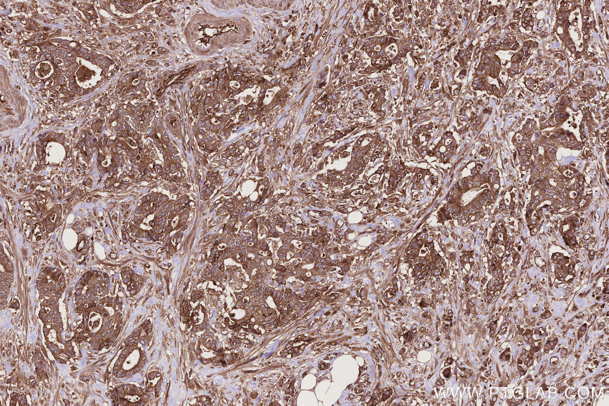 Immunohistochemical analysis of paraffin-embedded human rectal cancer tissue slide using KHC2769 (GEF-H1 IHC Kit).