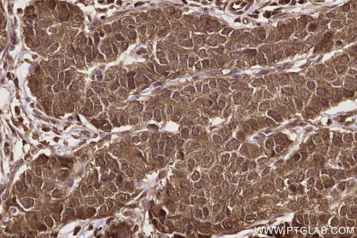 Immunohistochemical analysis of paraffin-embedded human stomach cancer tissue slide using KHC2725 (GEMIN5 IHC Kit).