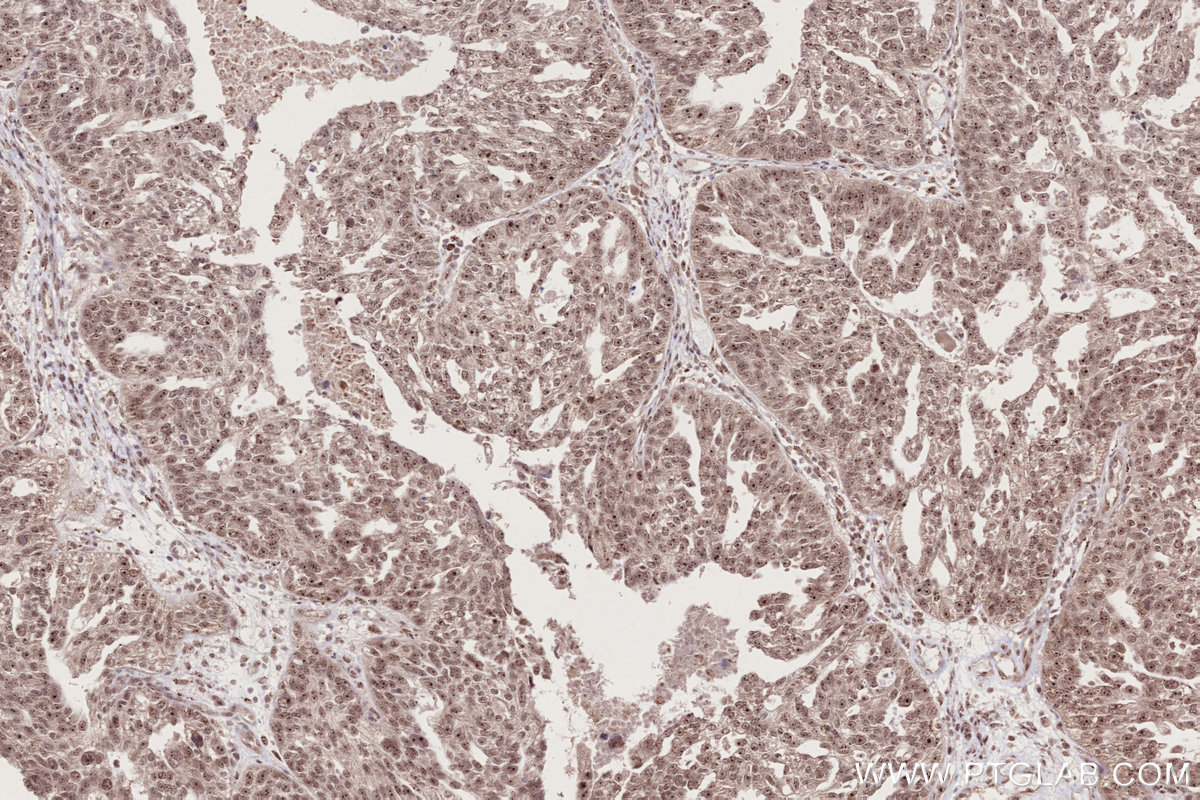 Immunohistochemical analysis of paraffin-embedded human ovary cancer tissue slide using KHC2739 (GEMIN6 IHC Kit).