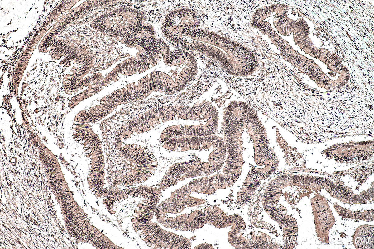 Immunohistochemical analysis of paraffin-embedded human colon cancer tissue slide using KHC0136 (GLI2-Specific IHC Kit).