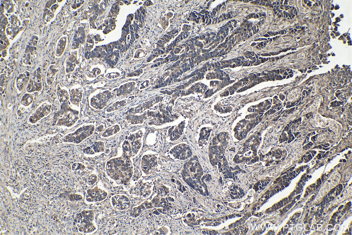 Immunohistochemical analysis of paraffin-embedded human stomach cancer tissue slide using KHC1379 (GLI2 IHC Kit).