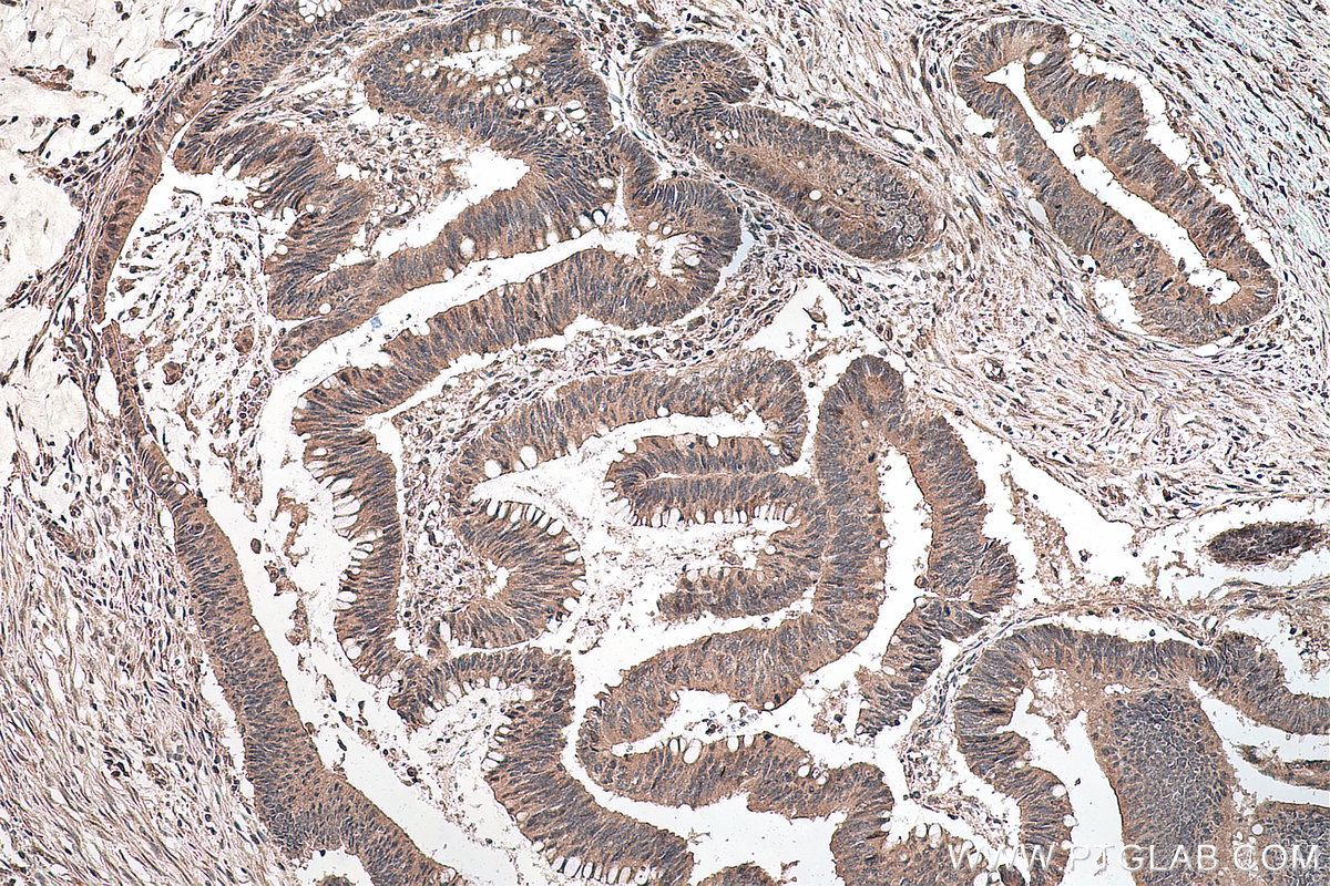 Immunohistochemical analysis of paraffin-embedded human colon cancer tissue slide using KHC0137 (GLI3 IHC Kit).