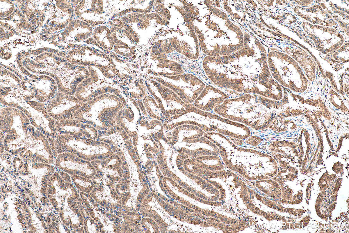 Immunohistochemical analysis of paraffin-embedded human ovary tumor tissue slide using KHC0694 (GLO1 IHC Kit).