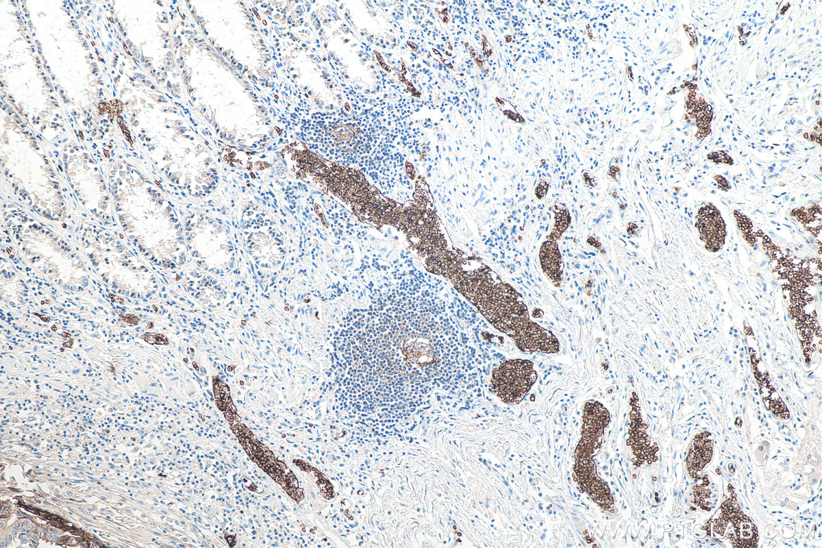 Immunohistochemical analysis of paraffin-embedded human colon cancer tissue slide using KHC0036 (GLUT1 IHC Kit). This view was captured from cancer adjacent region. Note that red blood cells are well stained. 