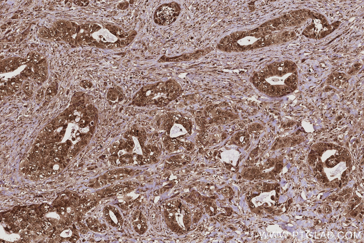 Immunohistochemical analysis of paraffin-embedded human pancreas cancer tissue slide using KHC2988 (GMIP IHC Kit). Immunohistochemical analysis of paraffin-embedded human pancreas cancer tissue slide using KHC2988 (GMIP IHC Kit).