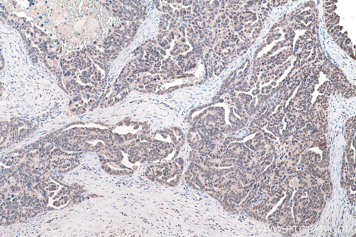 Immunohistochemical analysis of paraffin-embedded human ovary tumor tissue slide using KHC0890 (GMPS IHC Kit).