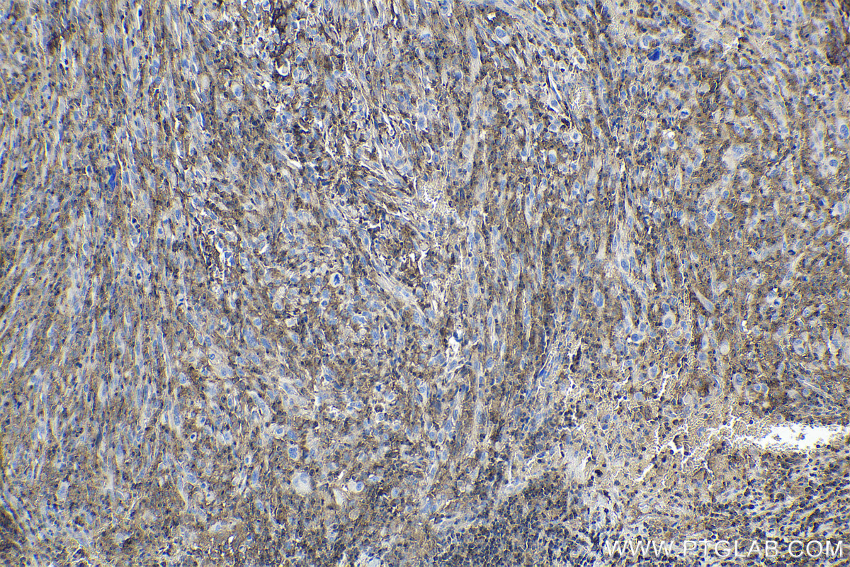 Immunohistochemical analysis of paraffin-embedded human skin cancer tissue slide using KHC1730 (GNA13 IHC Kit).