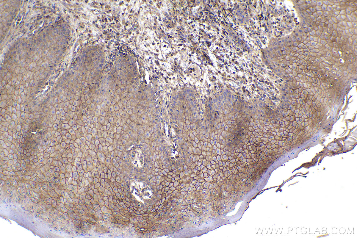 Immunohistochemical analysis of paraffin-embedded human skin cancer tissue slide using KHC2171 (GNAI3 IHC Kit).