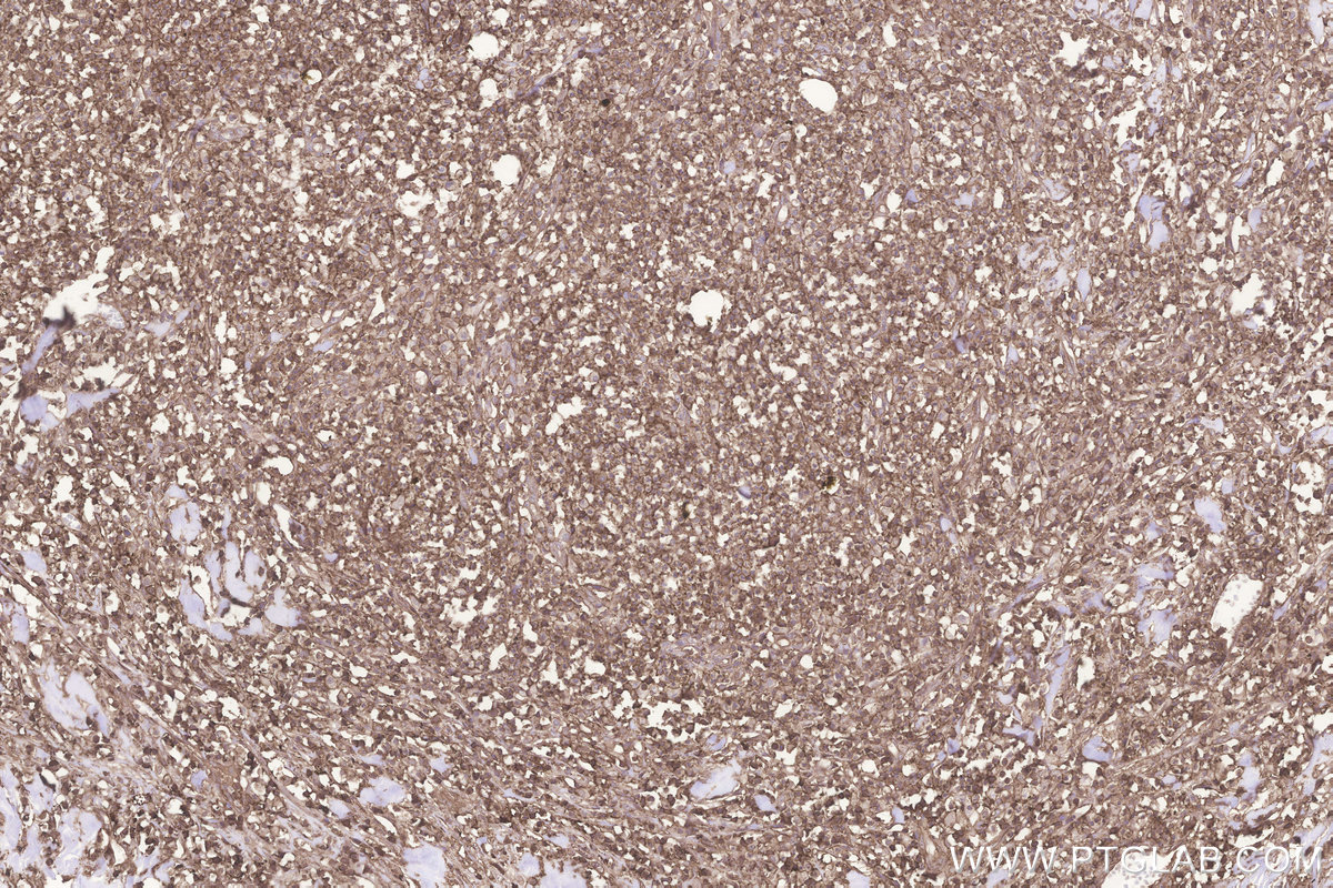 Immunohistochemical analysis of paraffin-embedded human colon cancer tissue slide using KHC3244 (GNB1 IHC Kit).