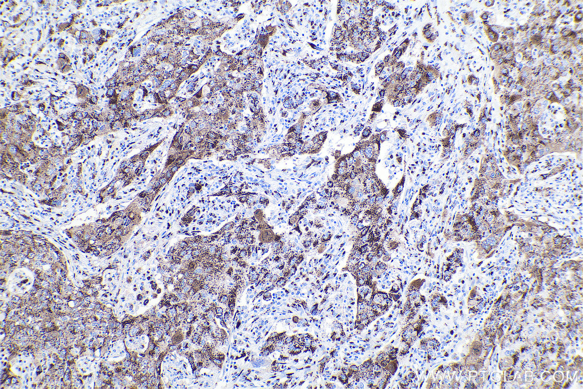 Immunohistochemical analysis of paraffin-embedded human lung cancer tissue slide using KHC0719 (GOLM1 IHC Kit).