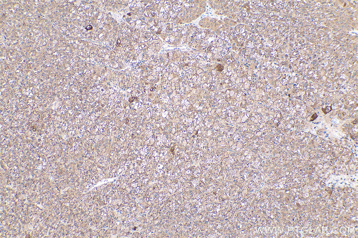 Immunohistochemical analysis of paraffin-embedded human liver cancer tissue slide using KHC0424 (GPX7 IHC Kit).