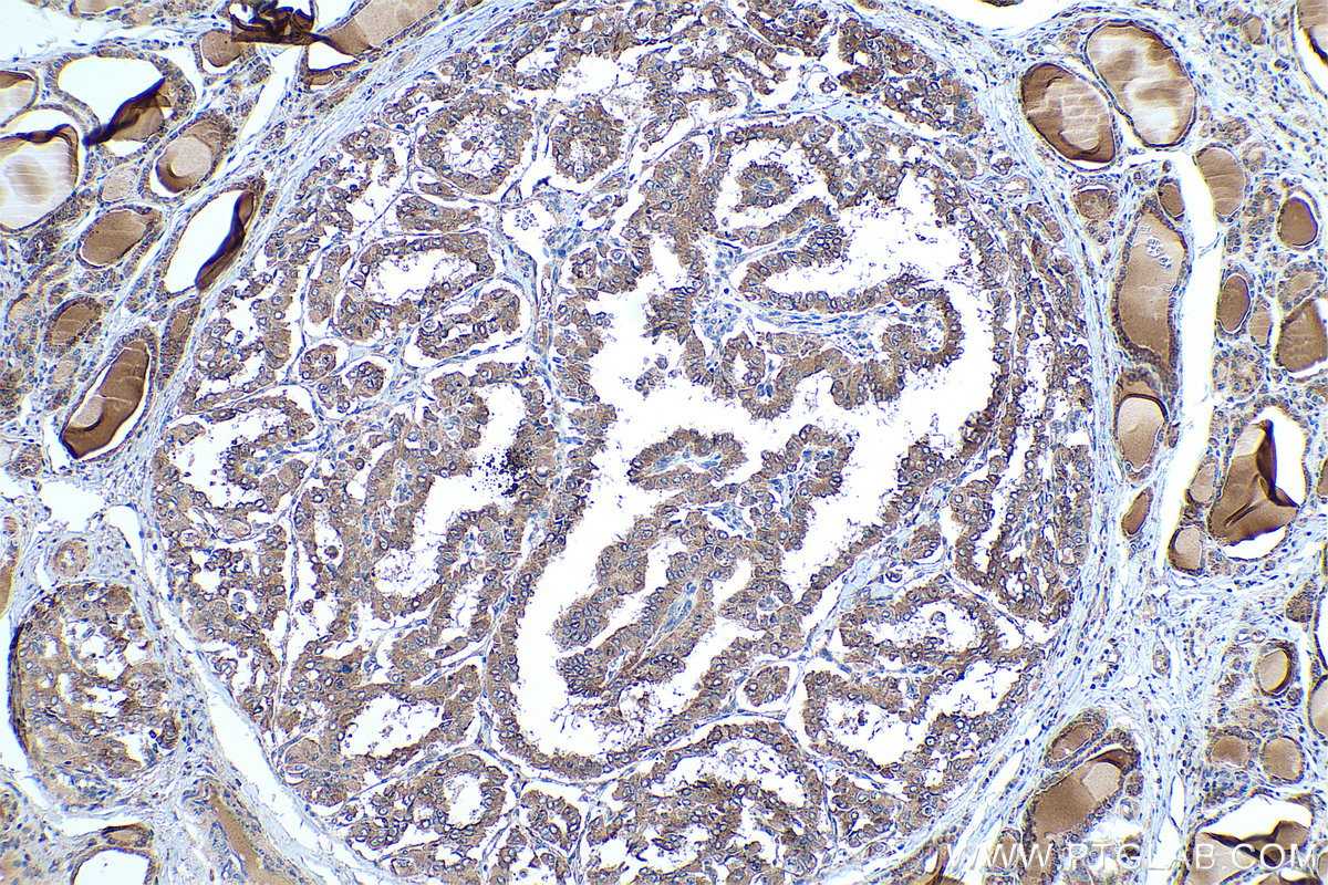 Immunohistochemical analysis of paraffin-embedded human thyroid cancer tissue slide using KHC0424 (GPX7 IHC Kit).