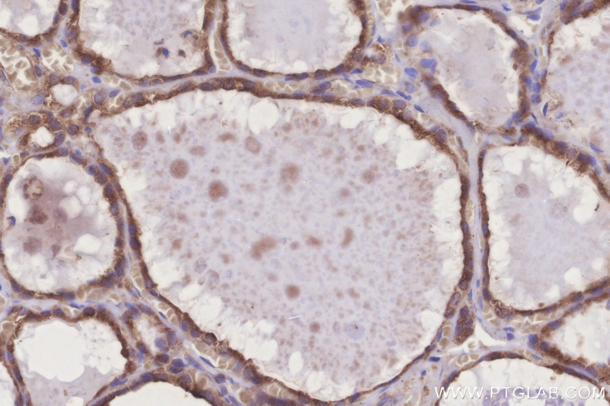 Immunohistochemical analysis of paraffin-embedded human thyroid cancer tissue slide using KHC3279 (GRINA IHC Kit).
