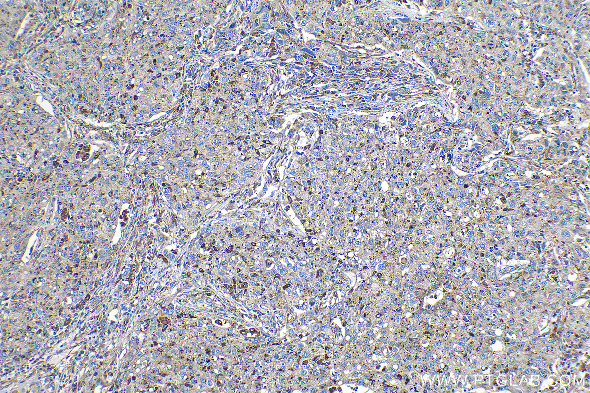 Immunohistochemical analysis of paraffin-embedded human lung cancer tissue slide using KHC1132 (GRN IHC Kit).