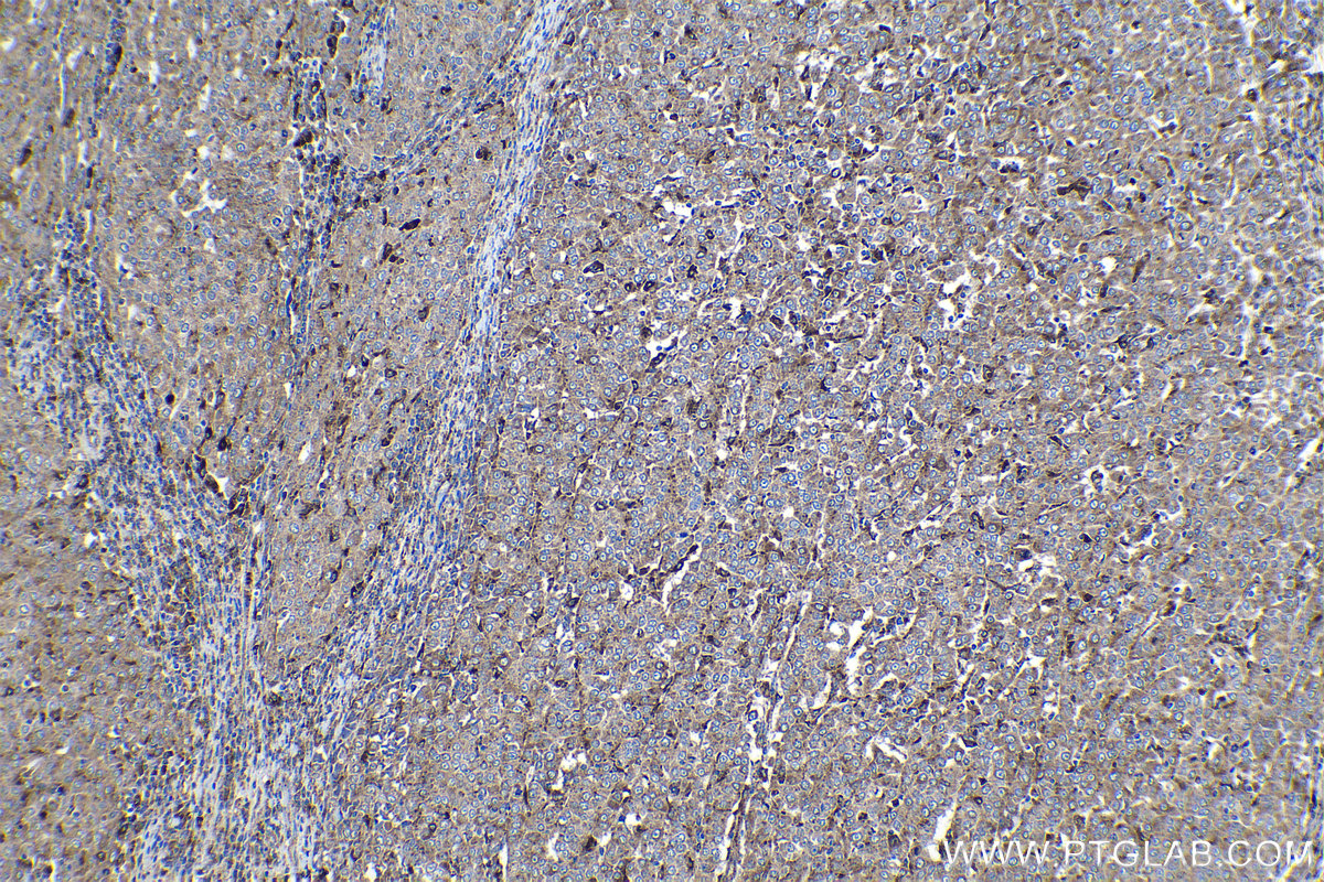 Immunohistochemical analysis of paraffin-embedded human ovary tumor tissue slide using KHC1132 (GRN IHC Kit).