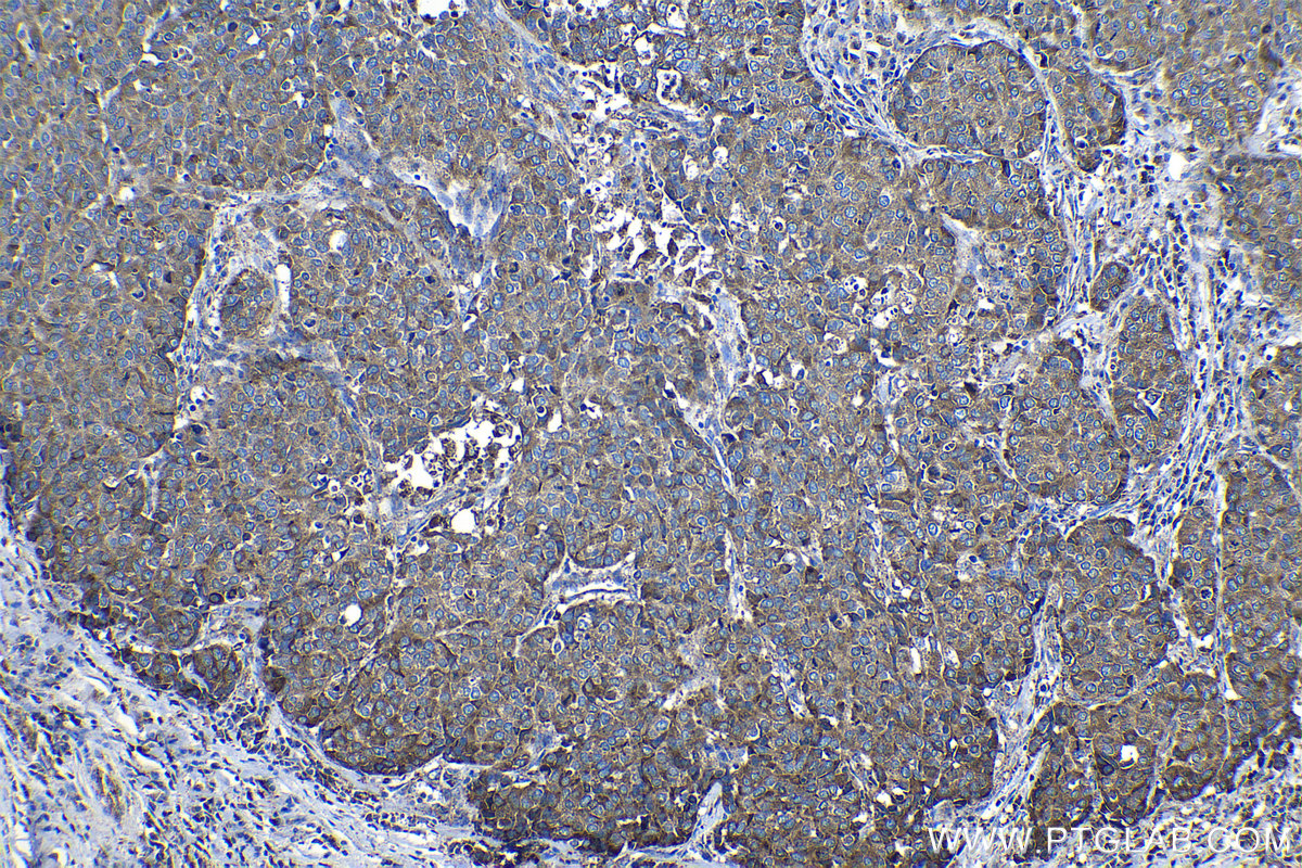 Immunohistochemical analysis of paraffin-embedded human stomach cancer tissue slide using KHC1132 (GRN IHC Kit).