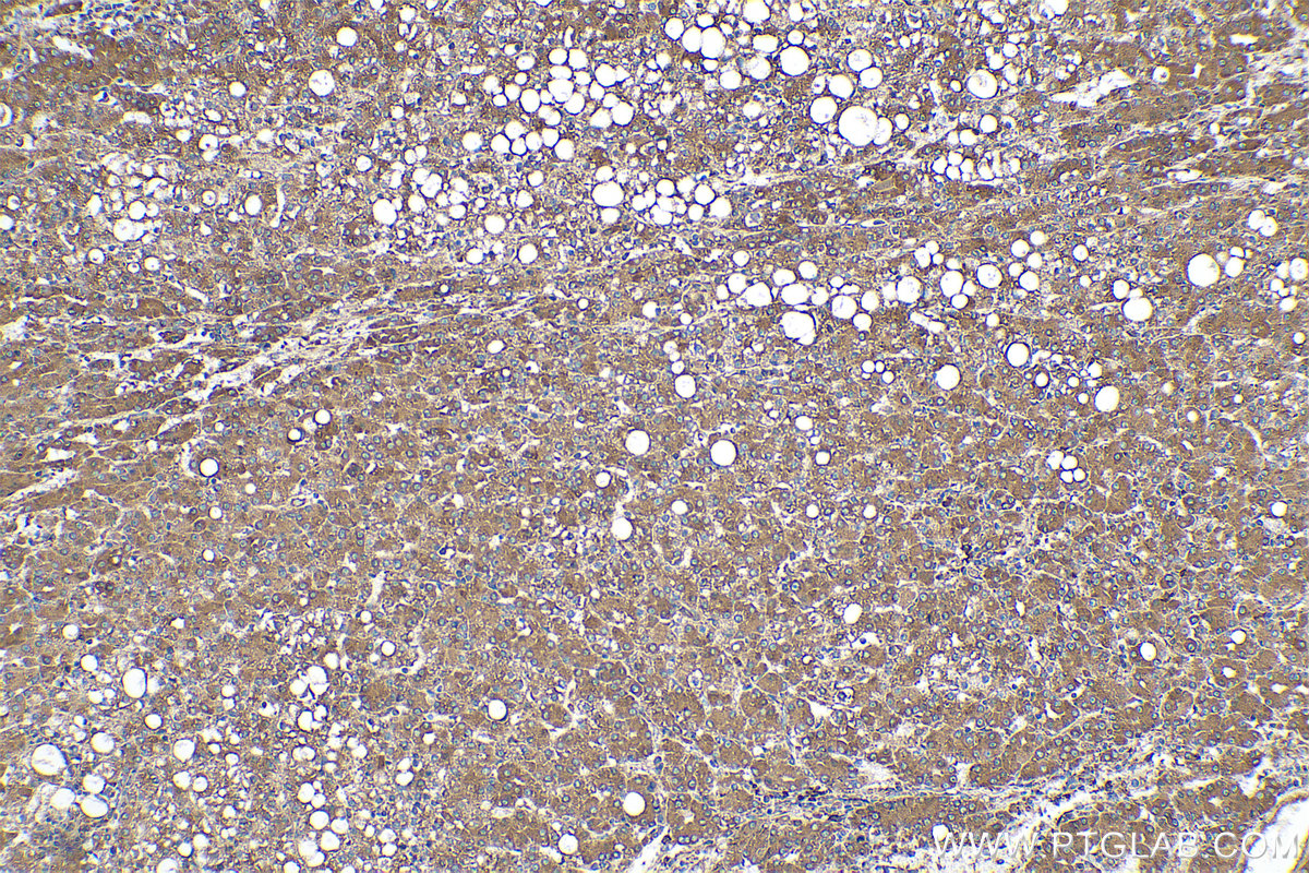 Immunohistochemical analysis of paraffin-embedded human liver cancer tissue slide using KHC0531 (GRP94/HSP90B1 IHC Kit).