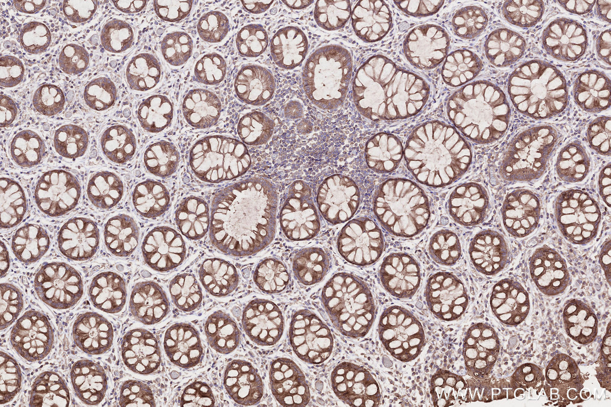 Immunohistochemical analysis of paraffin-embedded human rectal cancer tissue slide using KHC2660 (GSPT2 IHC Kit).