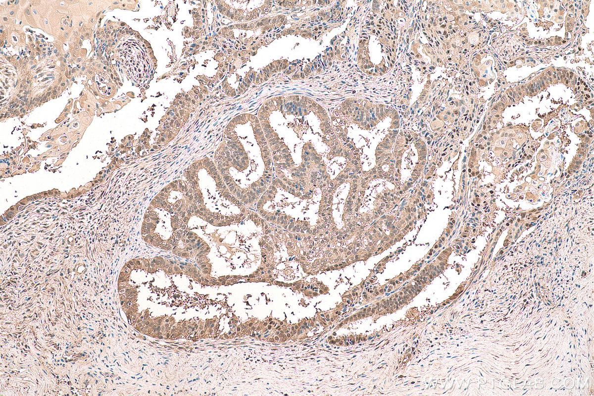 Immunohistochemical analysis of paraffin-embedded human ovary tumor tissue slide using KHC0781 (GSS IHC Kit).