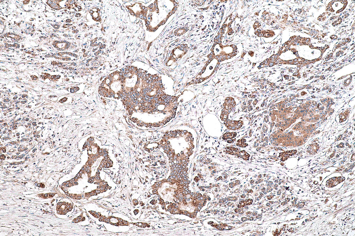 Immunohistochemical analysis of paraffin-embedded human pancreas cancer tissue slide using KHC0787 (GSTCD IHC Kit).