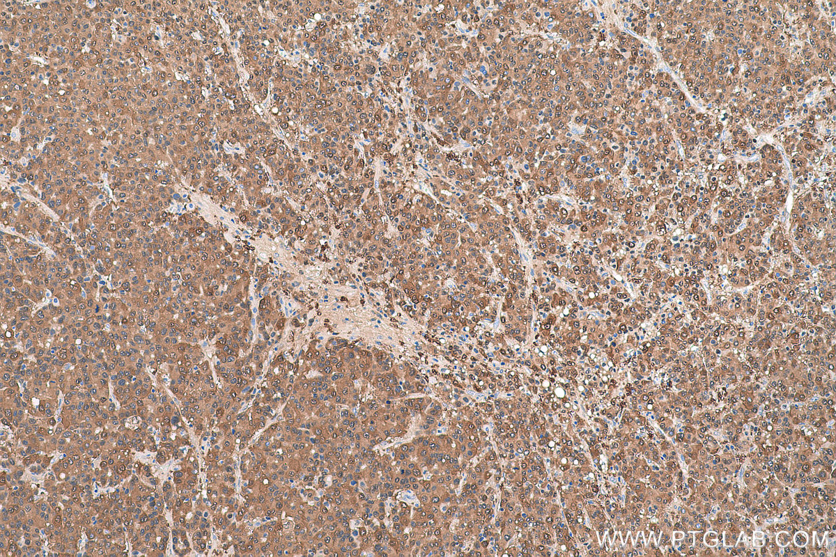 Immunohistochemical analysis of paraffin-embedded human liver cancer tissue slide using KHC0790 (GSTO1 IHC Kit).