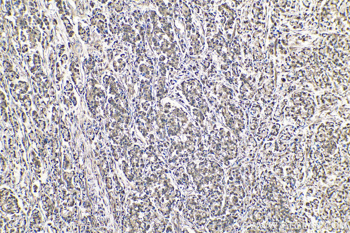 Immunohistochemical analysis of paraffin-embedded human colon cancer tissue slide using KHC0548 (GSTP1 IHC Kit).