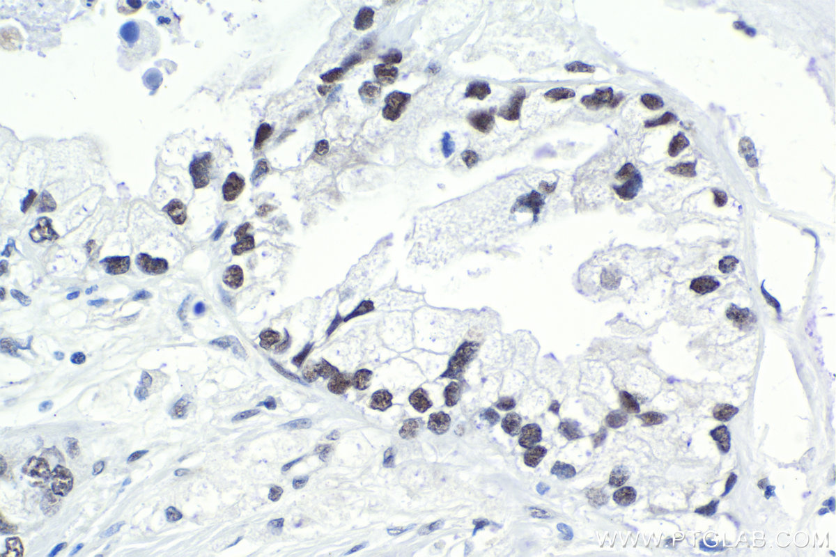 Immunohistochemical analysis of paraffin-embedded human pancreas cancer tissue slide using KHC1843 (GTF3C2 IHC Kit).